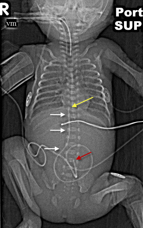 umbilcal venous catheter correct position